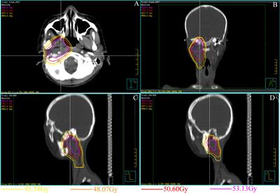 Modified Gap Arthroplasty for Temporomandibular Joint Ankylosis Following Radiotherapy for Rhabdomyosarcoma: Report of an Unusual Case and Brief Literature Review